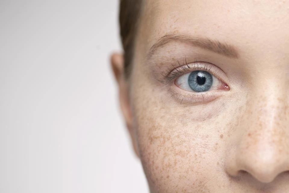 Understanding Sun Damage: How UV Rays Alter Skin and How CryoPen Can Reverse It Watford