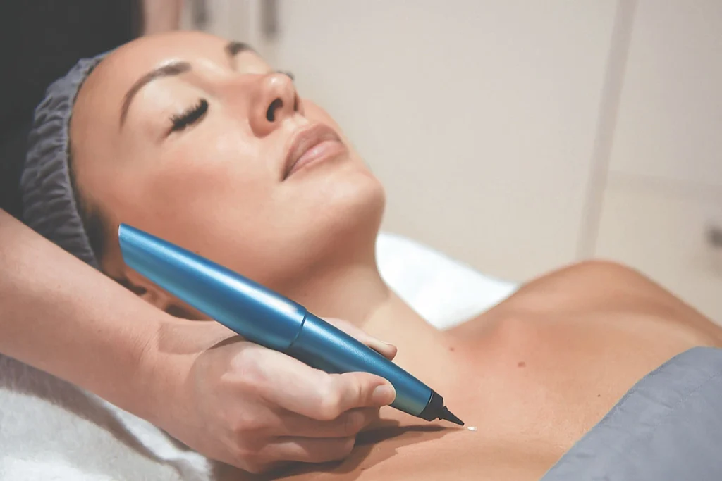 What is CryoPen Technology Watford? Watford