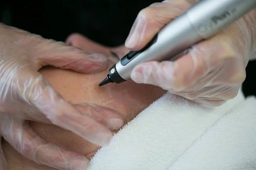 The CryoPen Technology Explained: How Extreme Cold Removes Sun-Damaged Skin Cells Watford