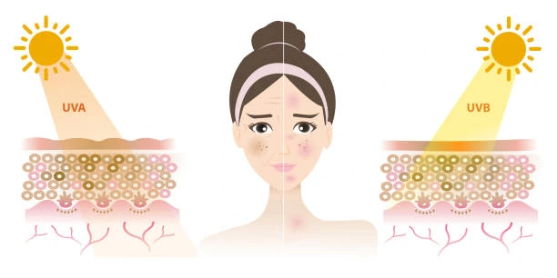 Understanding Sun Damage Watford : How Do UV Rays Cause Changes in the Skin? Watford