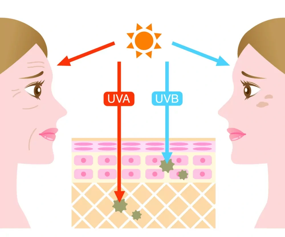 Understanding Sun Damage Watford - Why Should Sun Damage Be Treated Early? Watford